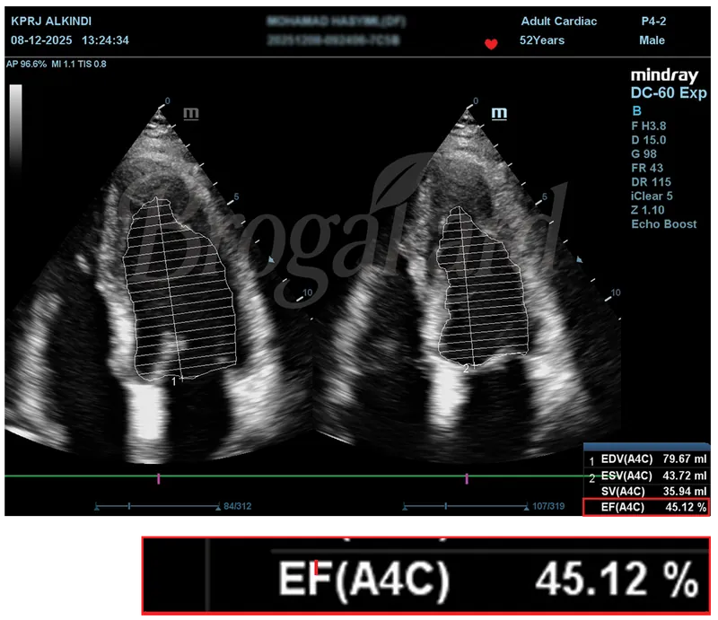 Hasil echocardiography sebelum terapi, EF 45,12%