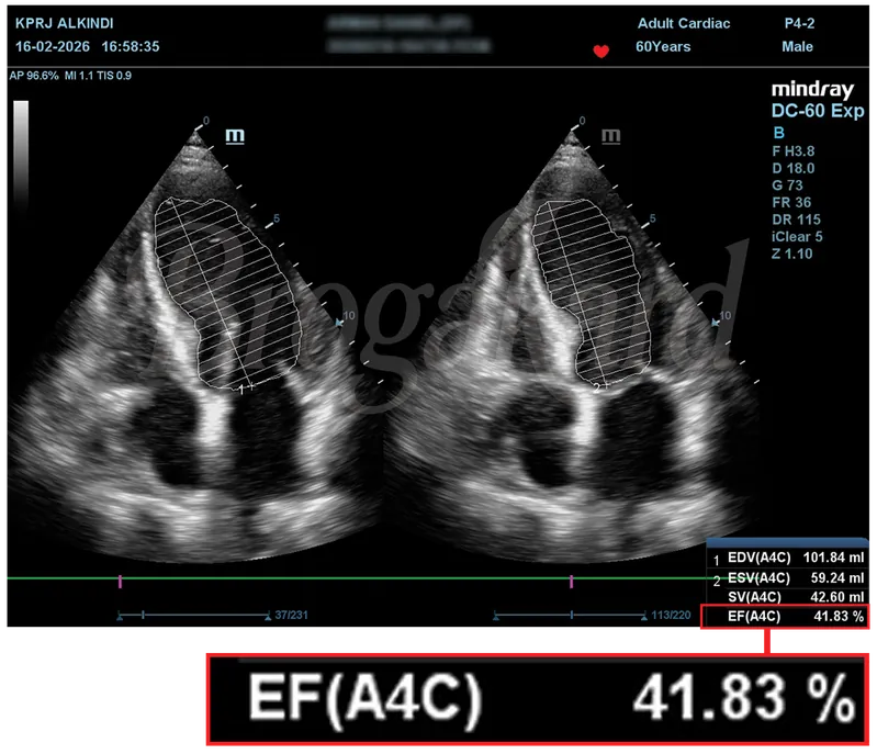 Hasil echocardiography sebelum terapi, EF 41,83%