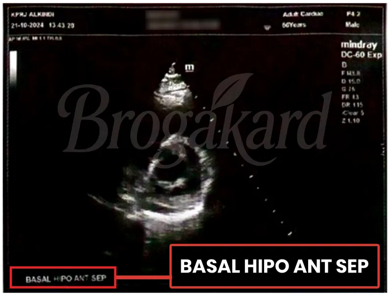 Hasil echocardiography sebelum terapi, pergerakan otot jantung bagian basal hipokinetik