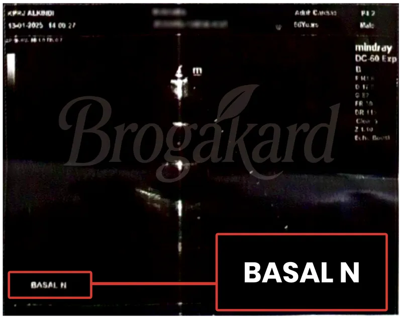 Hasil echocardiography setelah terapi, pergerakan otot jantung bagian basal normal